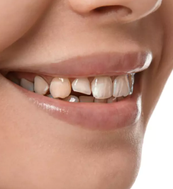 before smile
